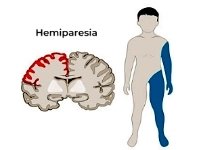 Hemiparesia