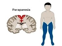 Paraparesia