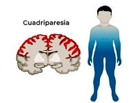 Cuadriparesia