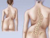 Escoliosis
