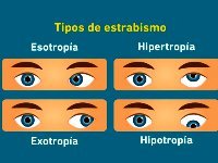 Estrabismo
