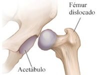 Luxación de cadera